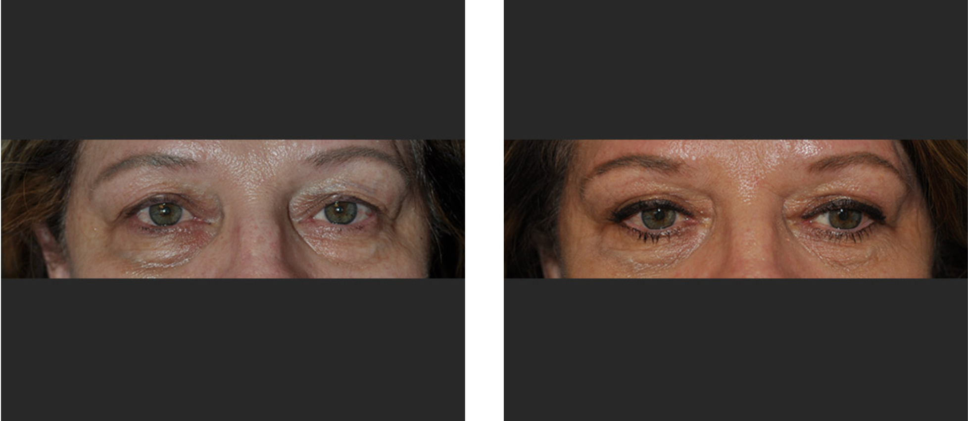 Before and After Eyelid Surgery