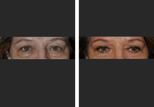 Blepharoplasty Gallery