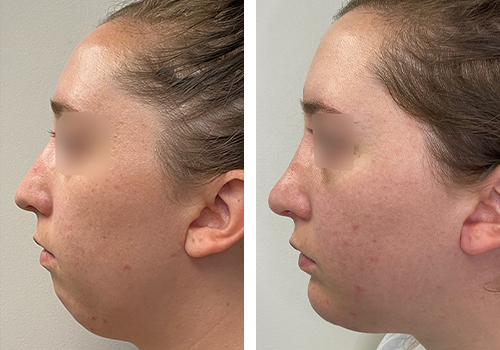 Chin Implant Gallery