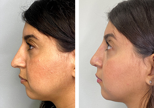 Revision Rhinoplasty Gallery