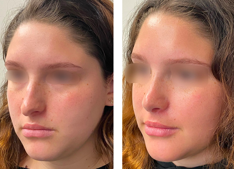 Female Rhinoplasty Before and After