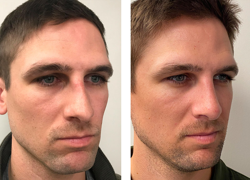 Cosmetic Rhinoplasty in Los Angeles - Sedgh Plastic Surgery