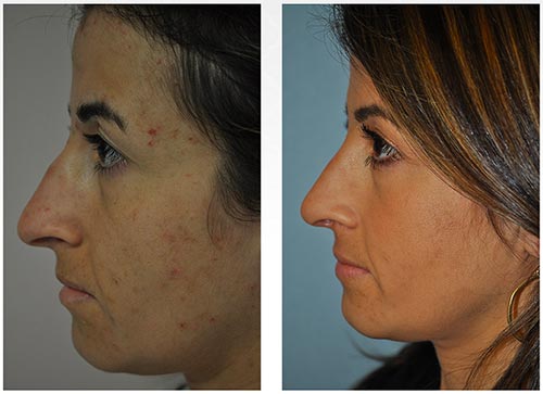 Before and after a closed rhinoplasty