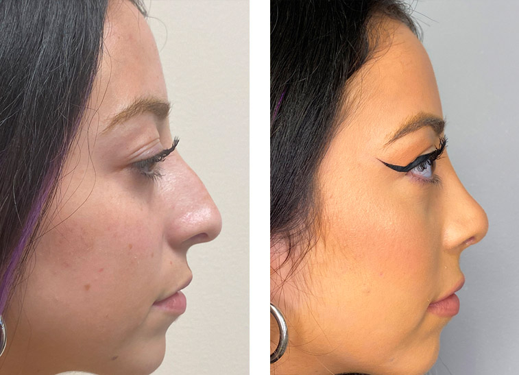 good nose job before and after