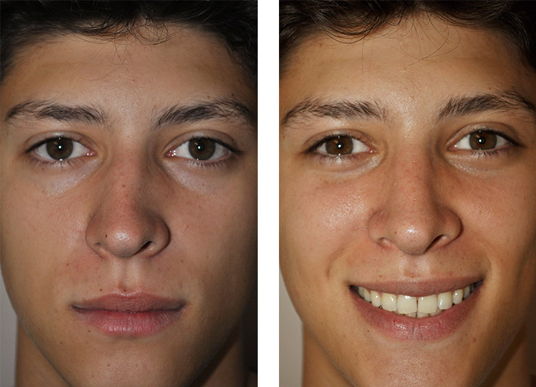 Septoplasty Before and After Images
